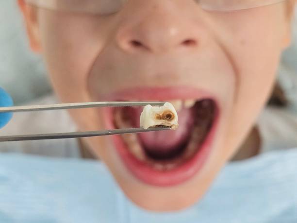 Best Emergency Wisdom Teeth Removal in Medina, WA